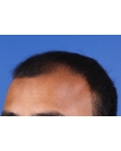 Before Hair Transplant&nbsp;Front